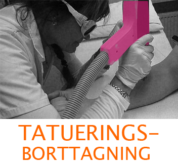 Tatueringsborttagning, laserklinik i Sundbyberg, Stockholm 